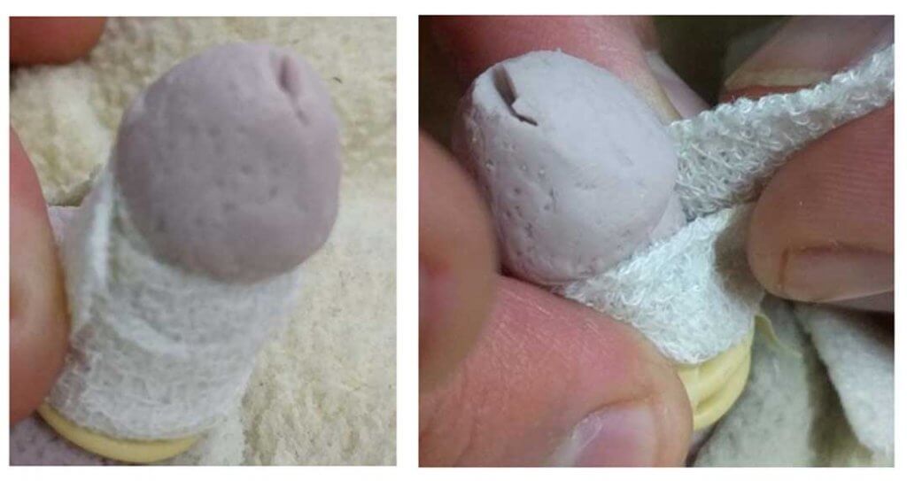 חבישה של הערלה